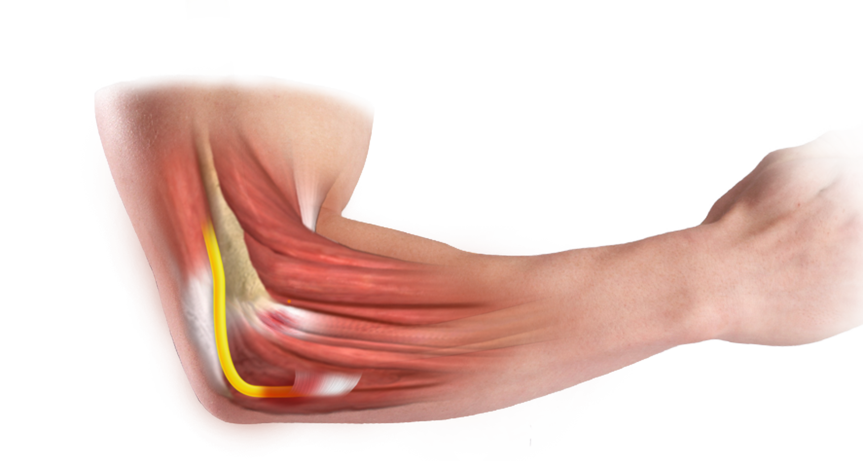 Cubital Tunnel Syndrome